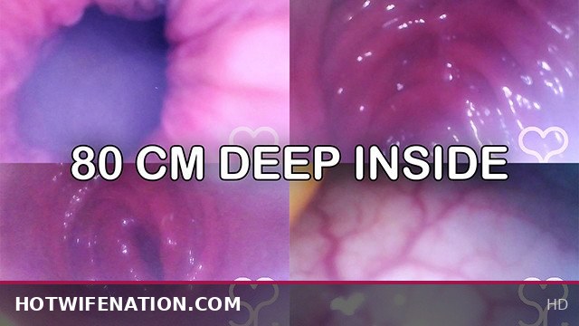 Anal Endoscope Inserted Deep Into My Transverse Colon – Full Video Featuring Exclusive Access